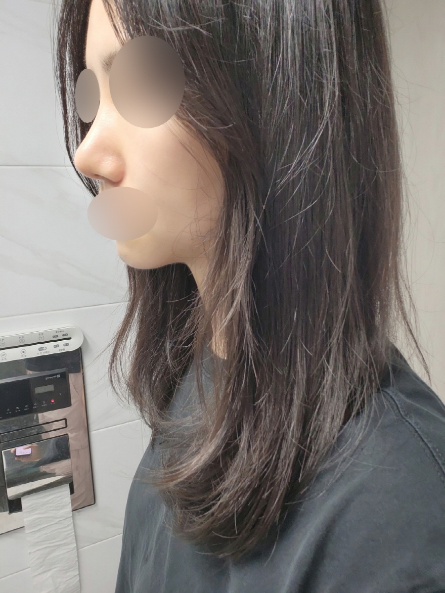 붓기가 많은 편이라 다른 사람보다 회복이 느리지만 기능적인 면이 정말 많이 좋아졌어요