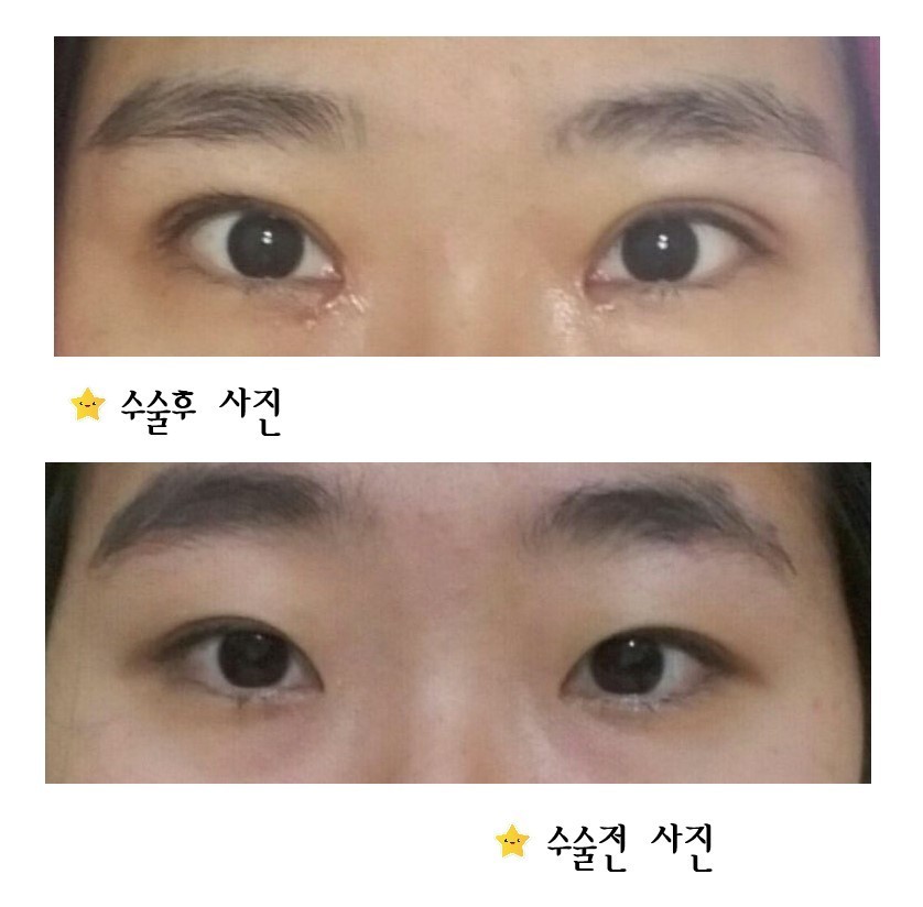 쌍꺼풀, 눈매교정, 앞트임
