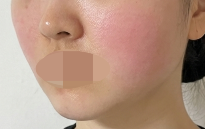 수면 진행 덕분에 부담 없이 받은 슈링크, 또 받으러 왔어요