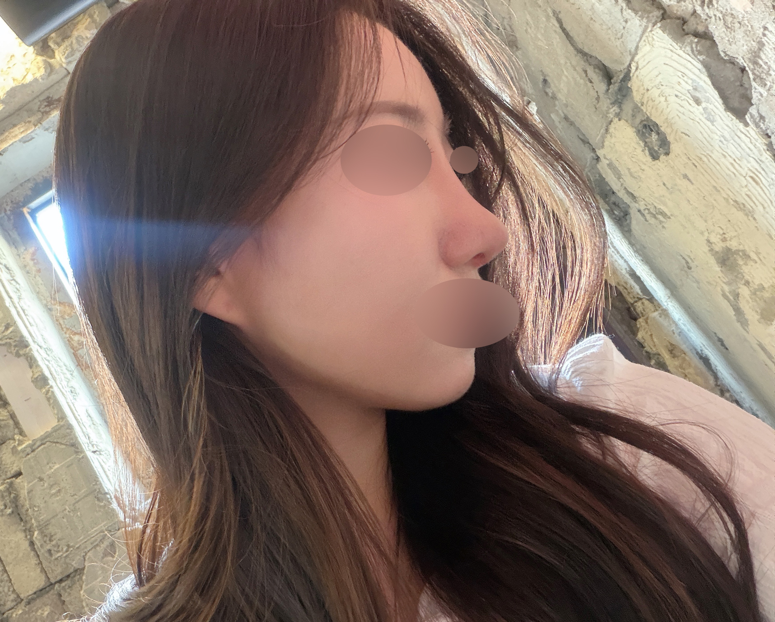 코재수술 2주차 후기, 역시 믿고 맡긴 선택이었어요