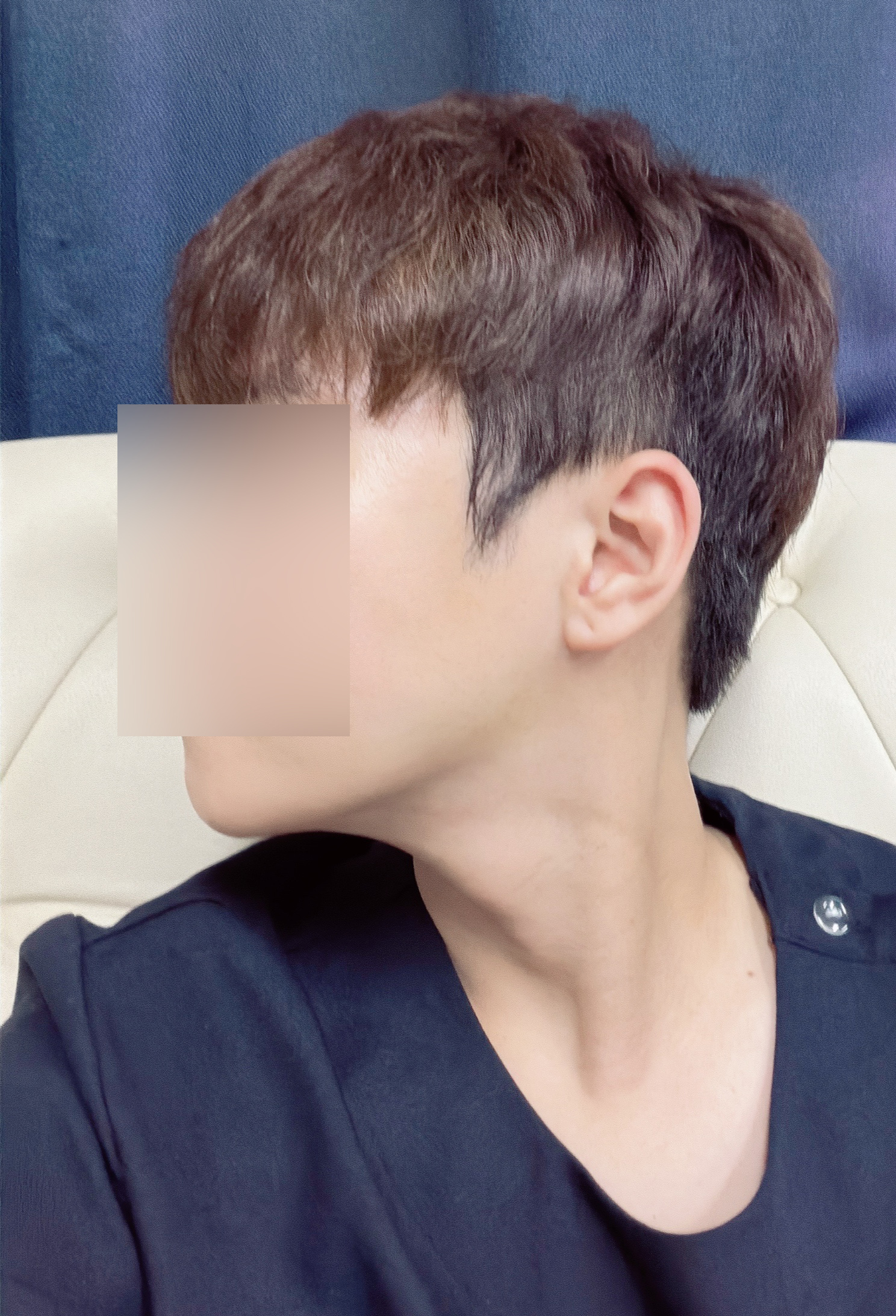 남자 턱끝+광대축소 2달 후기, 점점 완성되는 얼굴 라인이 만족스럽습니다.
