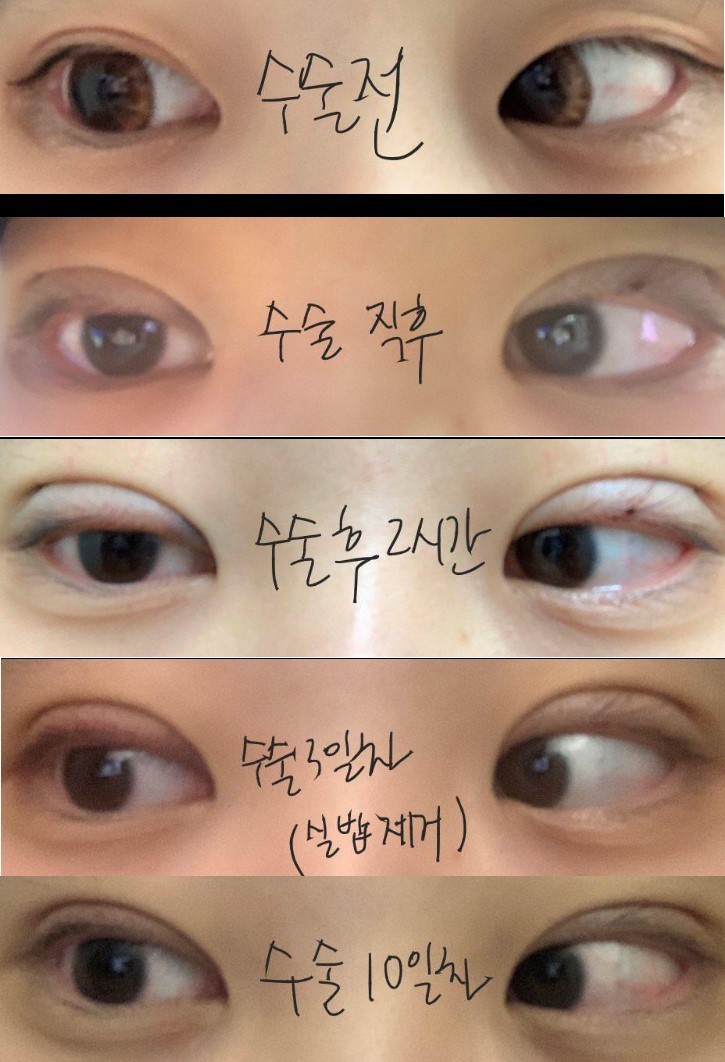 눈재수술