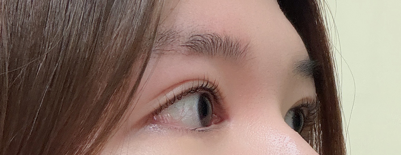 답답했던 눈매가 시원해졌어요, 앞윗트임 4개월!