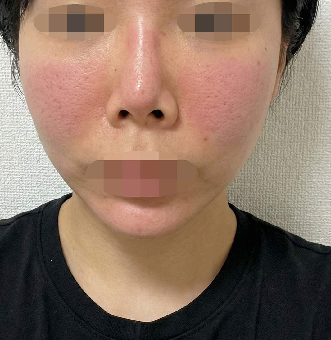 여드름 때문에 포텐자 받았는데 시술 끝나고 바로 좋아진 것 같아요ㅎㅎ