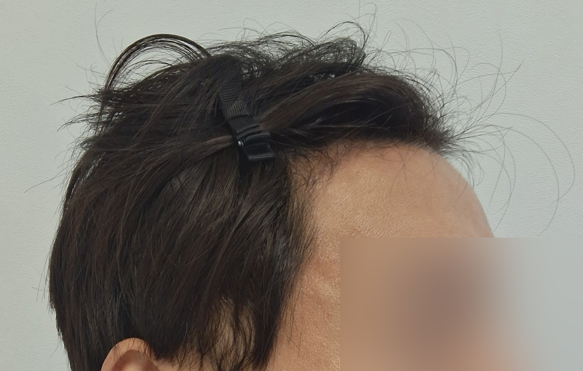 절개 모발이식한지 2개월입니다. 암흑기를 지나 변화가 시작됐어요.