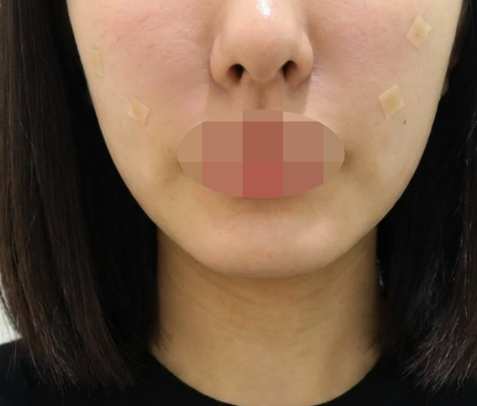 병원 분위기도 좋고 시술까지 세심해서 믿고 맡길 수 있었어요~