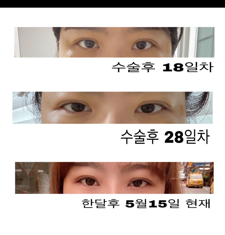 눈재수술