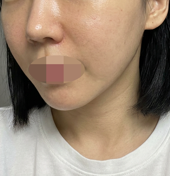 양 볼 홍조랑 트러블 고민, 리쥬란으로 7일 차에 변화 느꼈어요~