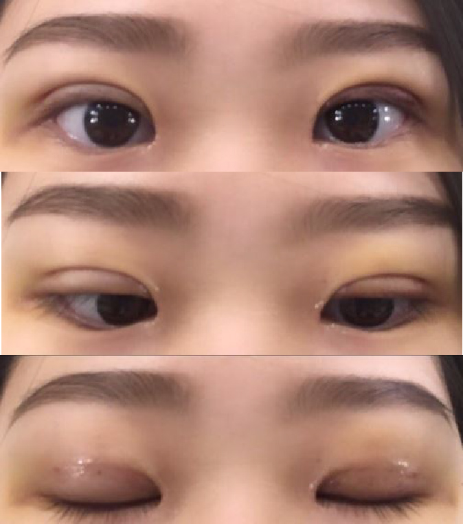 쌍수받고 매일이 즐거워요!