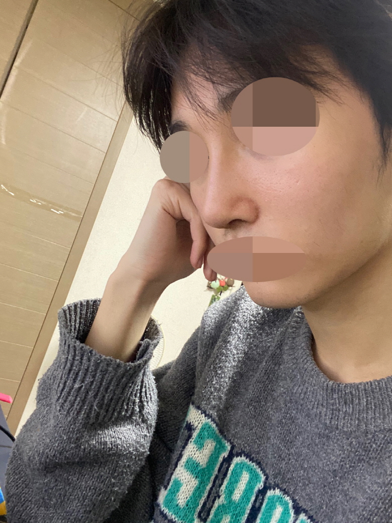 고민 엄청하고 수술 받았는데 너무 예쁘게 잘 됐습니다