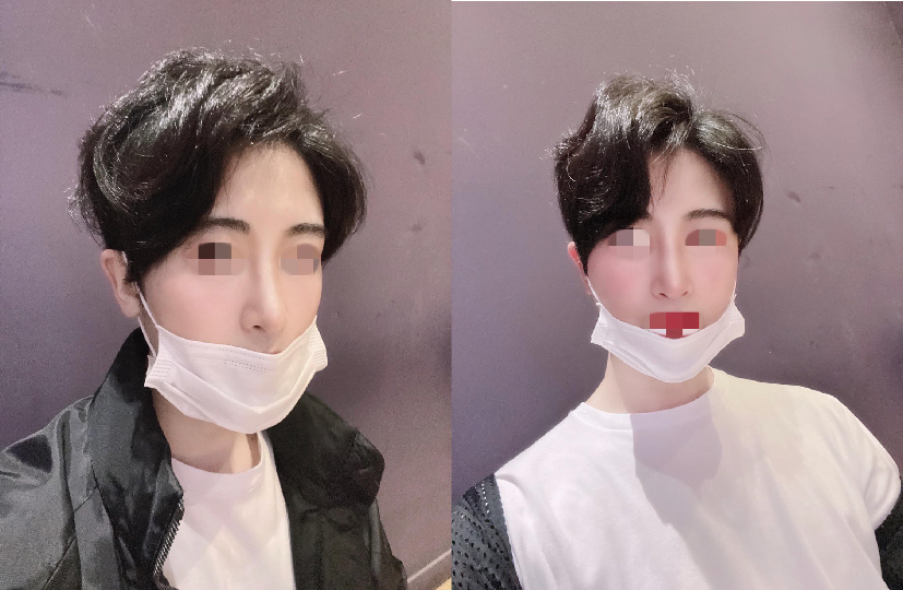 눈코수술 후기,...