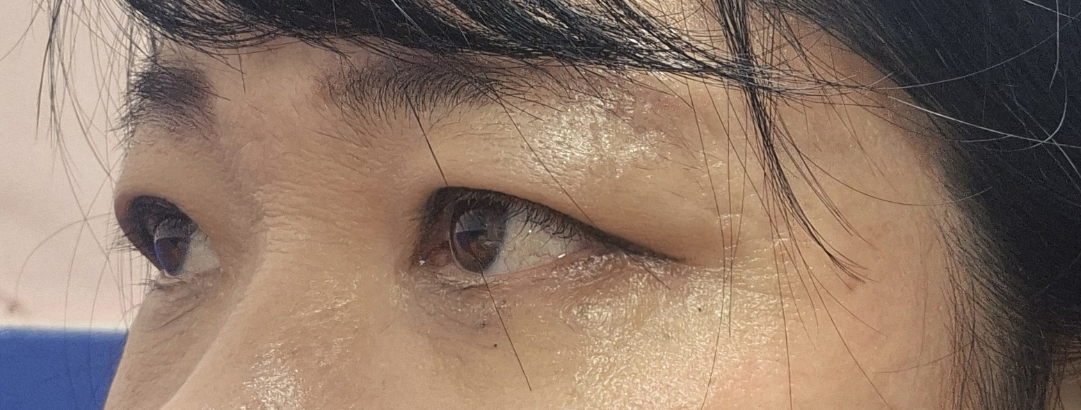 하안검·눈밑지방이식 2차 후기, 거울 볼 때마다 만족 중입니다
