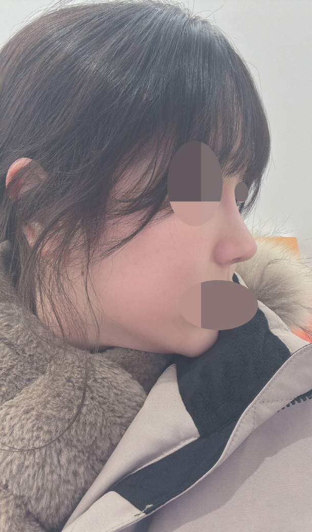 이제 통증도 없고 너무 이쁘게 빠지고 있습니다!