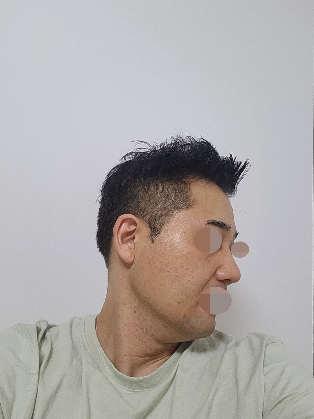 비용도, 수술 만족도도 모두 좋습니다. 합리적이고, 추천합니다