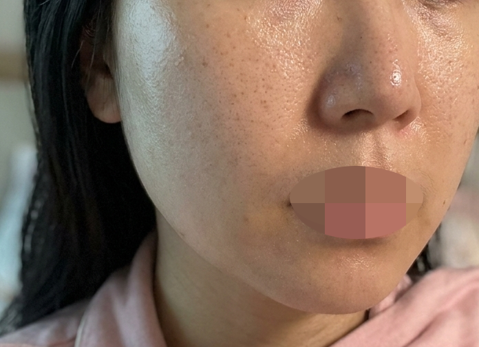 평소엔 리즈네만 받았는데 이번엔 스킨보톡스까지 같이 받아봤어요!!