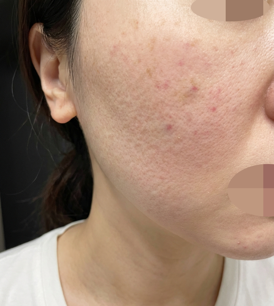 대기 시간도 짧고, 무엇보다 피부 건조해서 리쥬란 받았는데 꼼꼼해서 좋은 것 같아요ㅎㅎ
