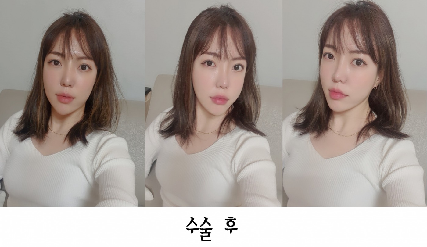 코재수술
