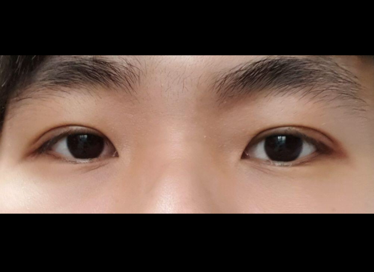 자연유착 수술 후기