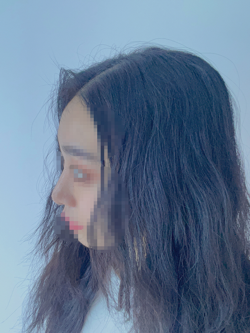 코 수술 추천이요
