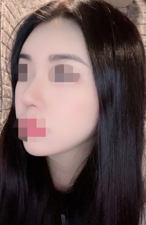 수술하길 잘 했다는 생각들어요????
