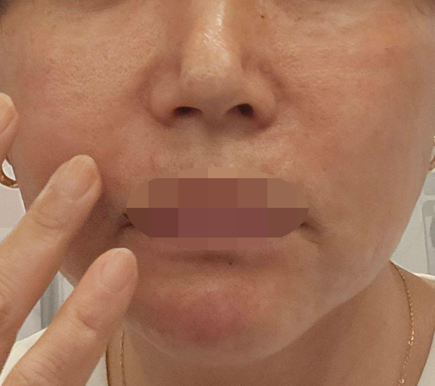통증도 참을 만하고 편의성까지 좋은 리쥬란 받아봤어요