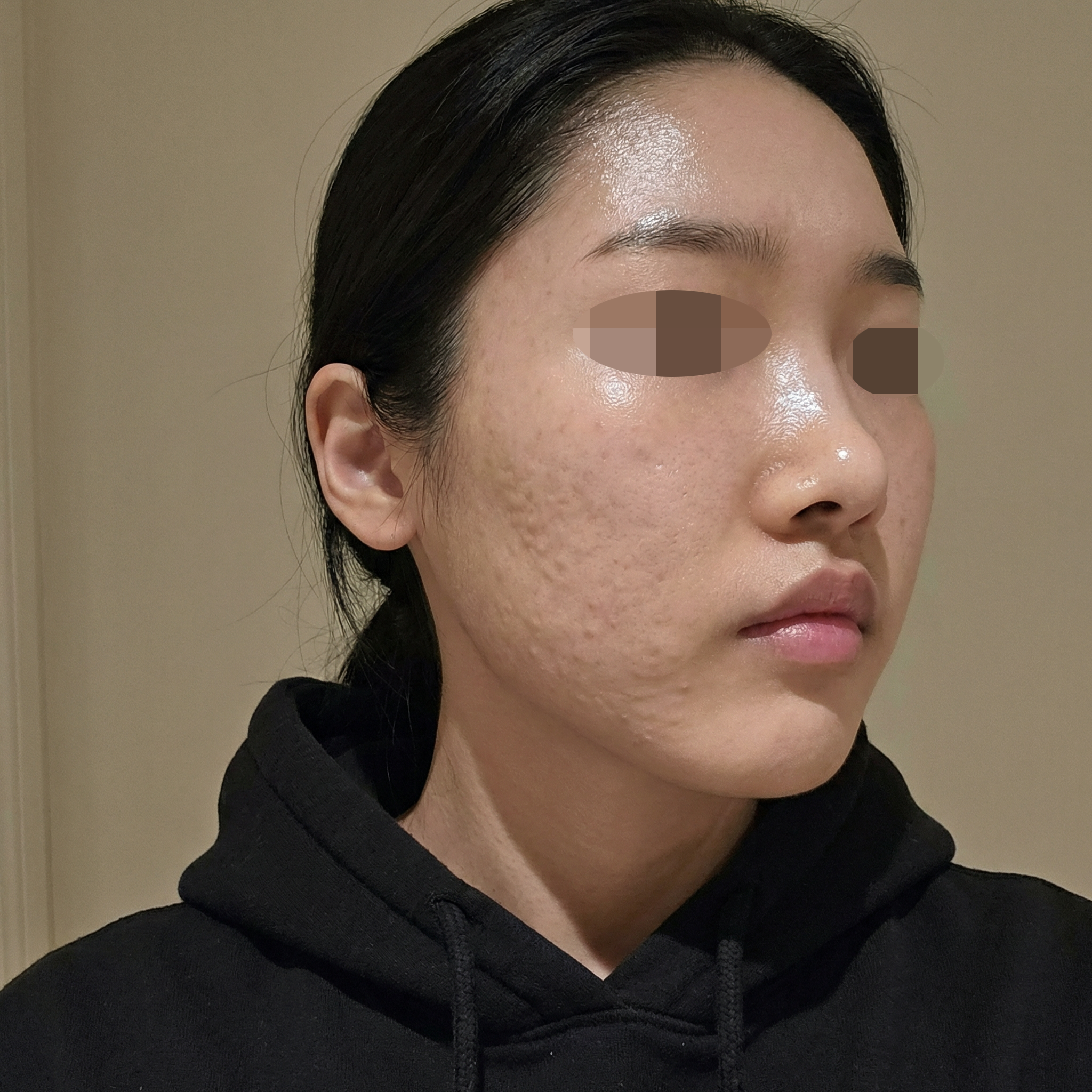 한번 너무 아팠던 기억에 수면으로 바꿨는데 진짜 편해요!