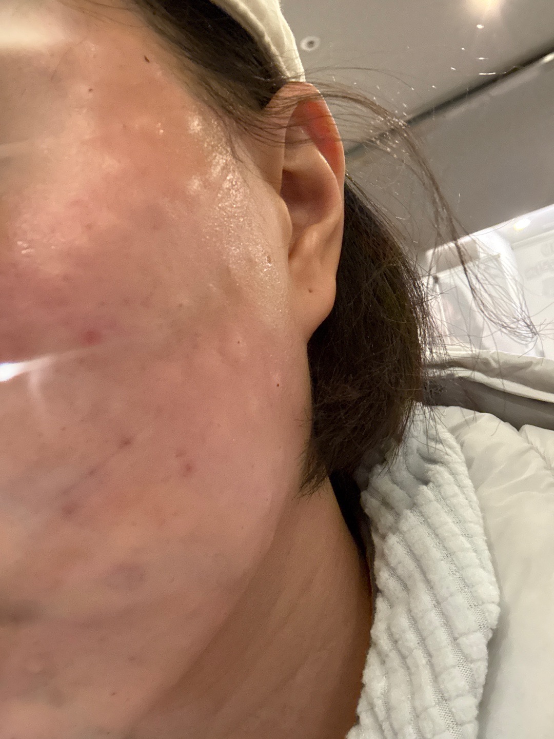 수면 리쥬란 받았는데 눈 감았다 뜨니까 끝나 있어서 좋았어요 ㅎㅎ
