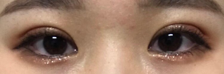 눈매교정+쌍꺼풀