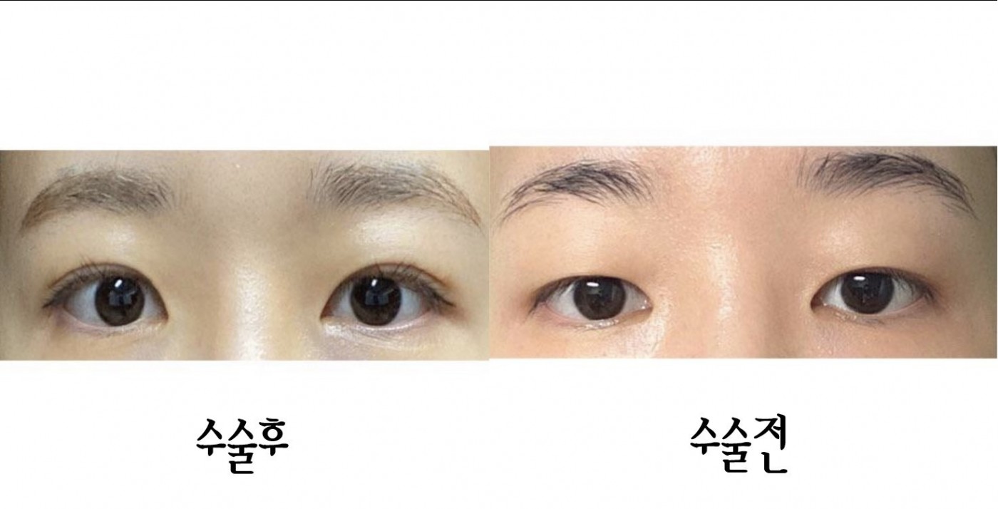 눈매교정+쌍수