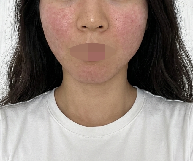 첫 수면 리쥬란 걱정 많았는데, 친절하게 챙겨주셔서 안심했어요ㅎㅎ
