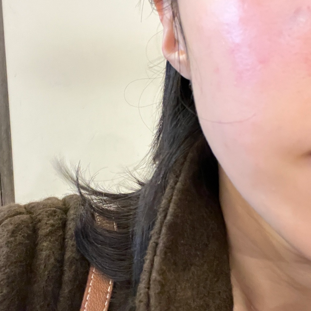 눈밑 잔주름이랑 레이저 후 재생관리때문에 받았어요!