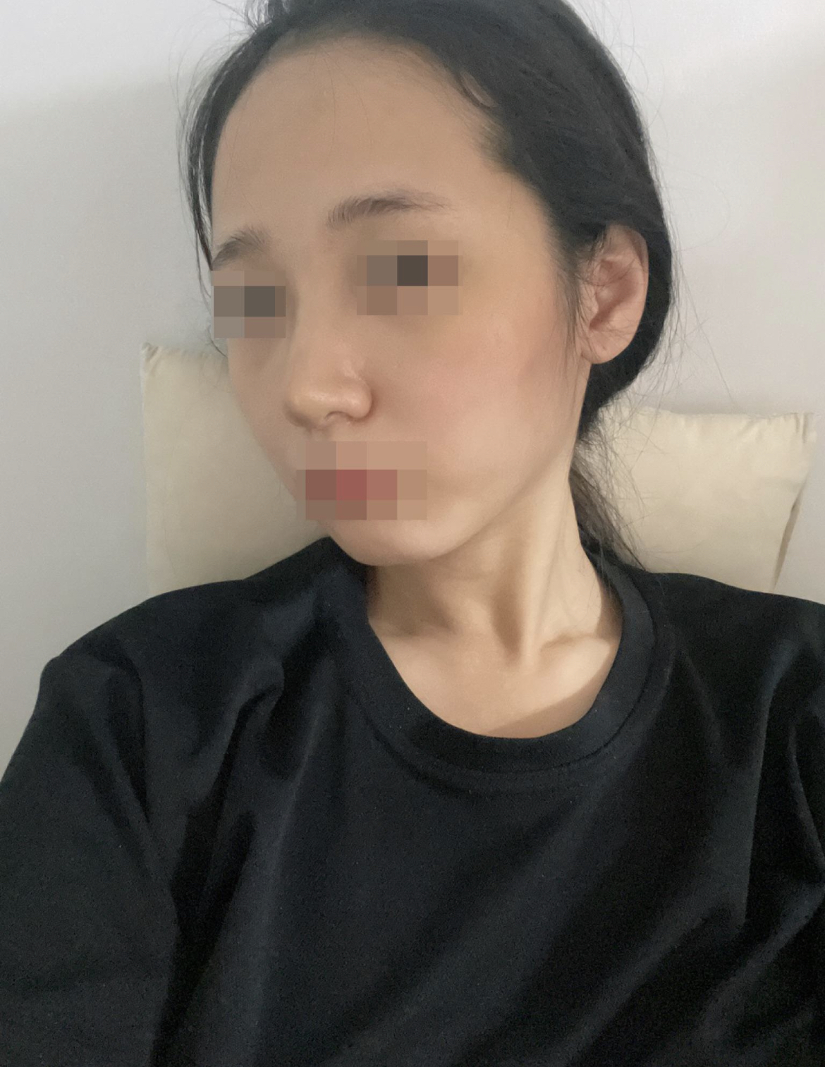 몇년간 고민하다 수술받은만큼 만족하는 결과 나와서 너무 좋아요 !!!