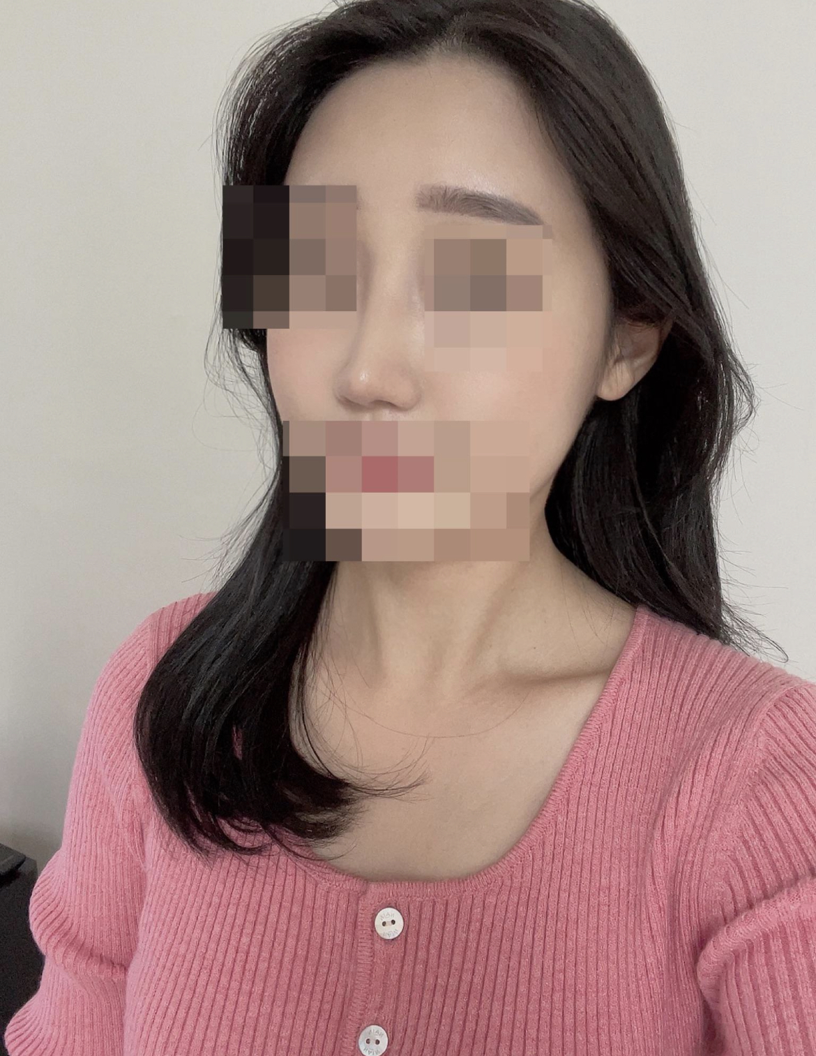 자연스럽게 수술 해주신 황정일 원장님께 감사드려요~~