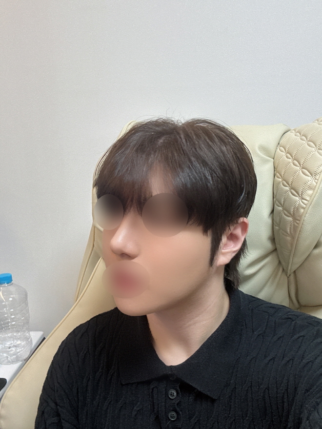 붓기가 전체적으로 많이 빠졌고 간간히 있던 통증도 없어졌습니다!