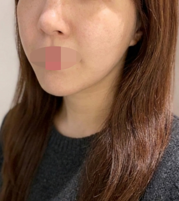 리프팅 처음인데 자세하게 상담해줘서 마음 놓였어요!