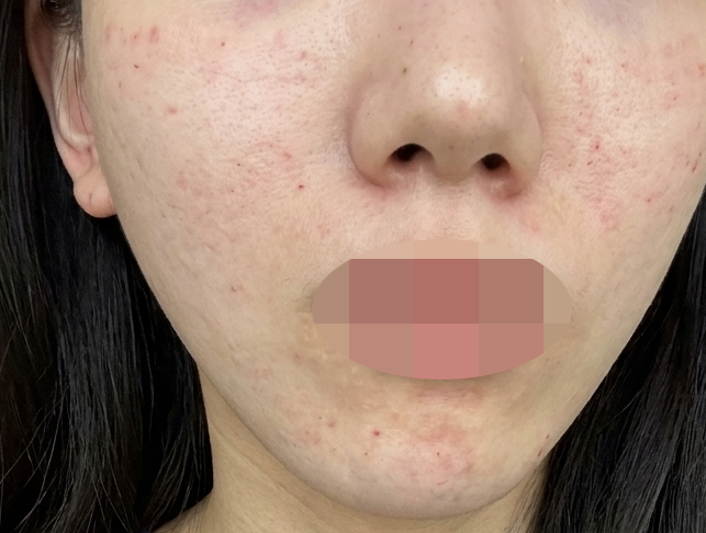 화장 들뜸 끊어내려고 받은 리쥬란, 결과 기대돼요!