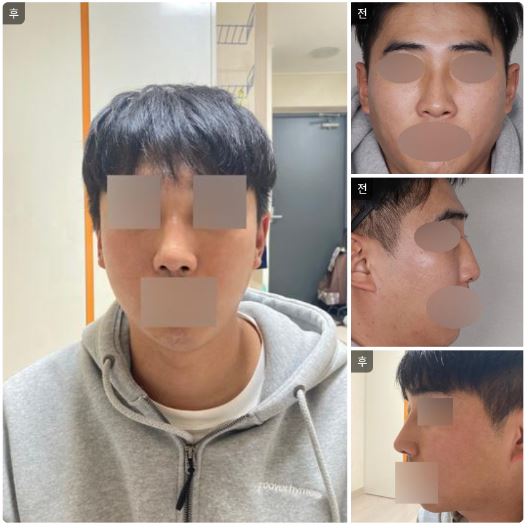 수술후 한달차 후기 올립니다