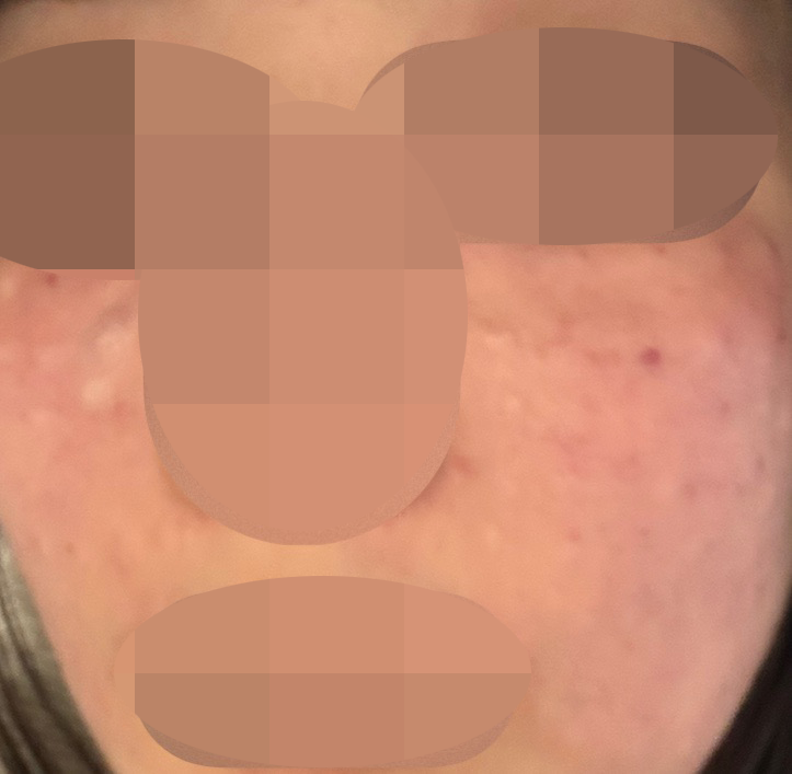 모공이랑 피부결 고민으로 쥬브아셀 받아봤어요!