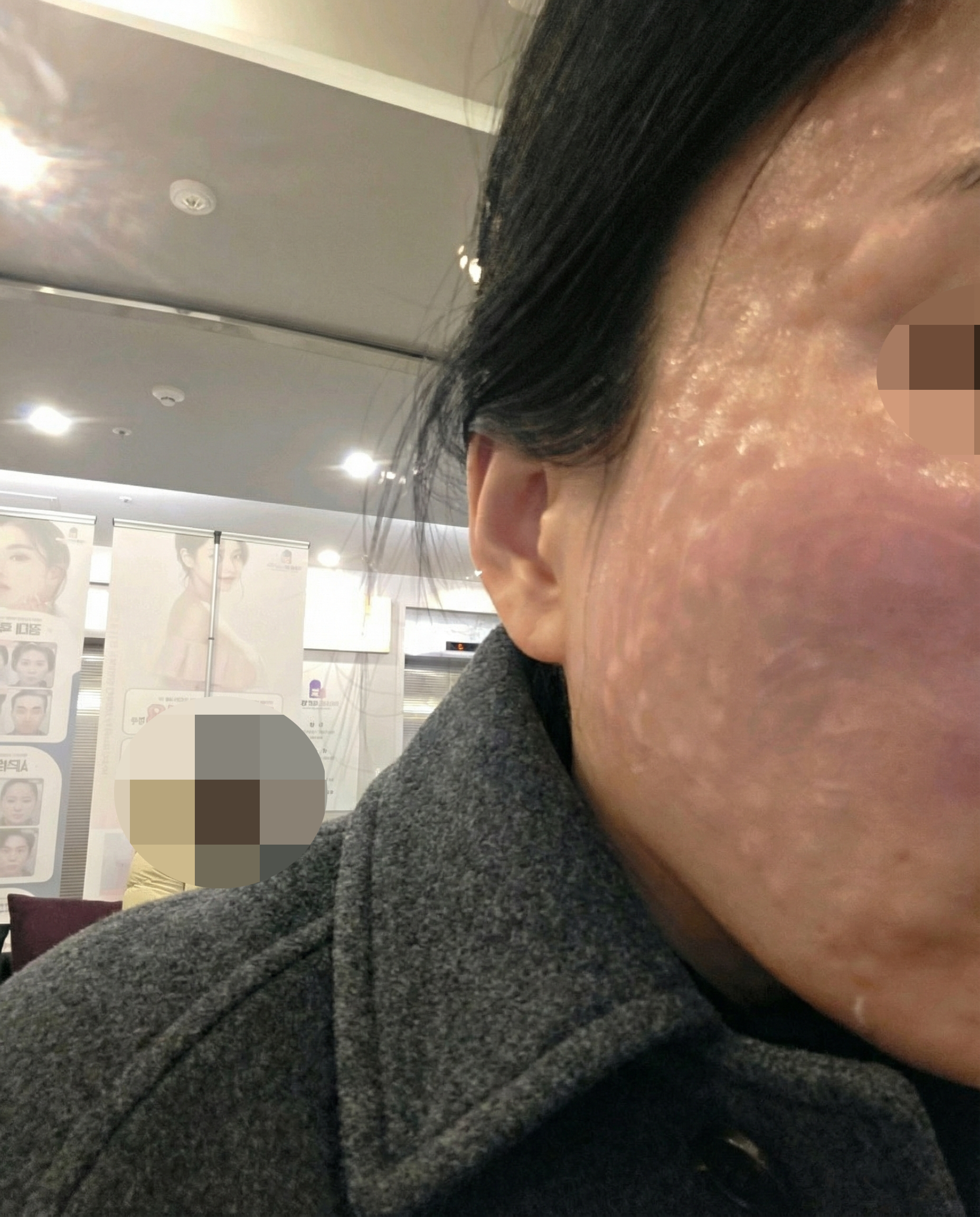 리쥬란 촘촘하게 잘 받고 왔어요 – 원장님 최고!