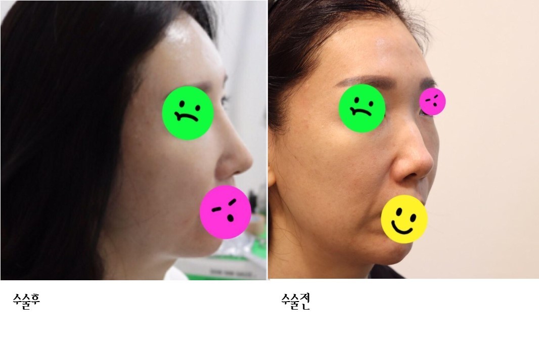 낮은 코 매부리 수술 했어요~