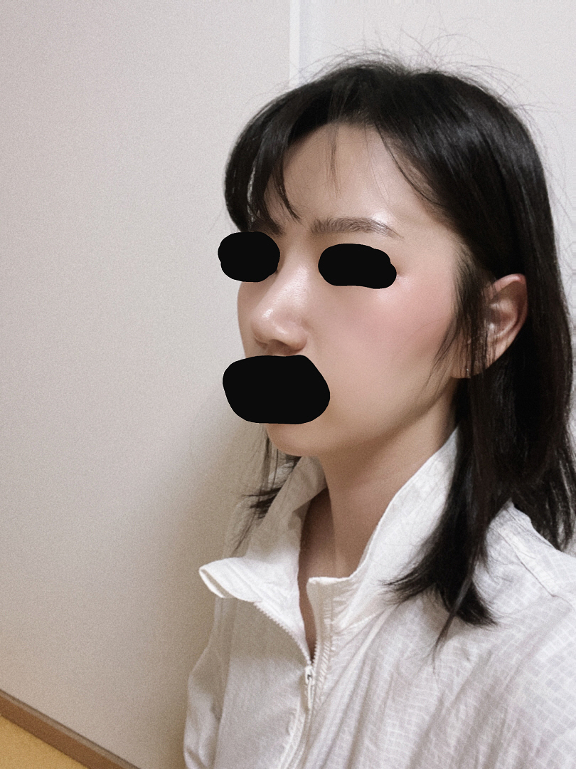 황정일 원장님깨 수술받아서 이제 재수술은 없을거라서 너무 좋아요 !