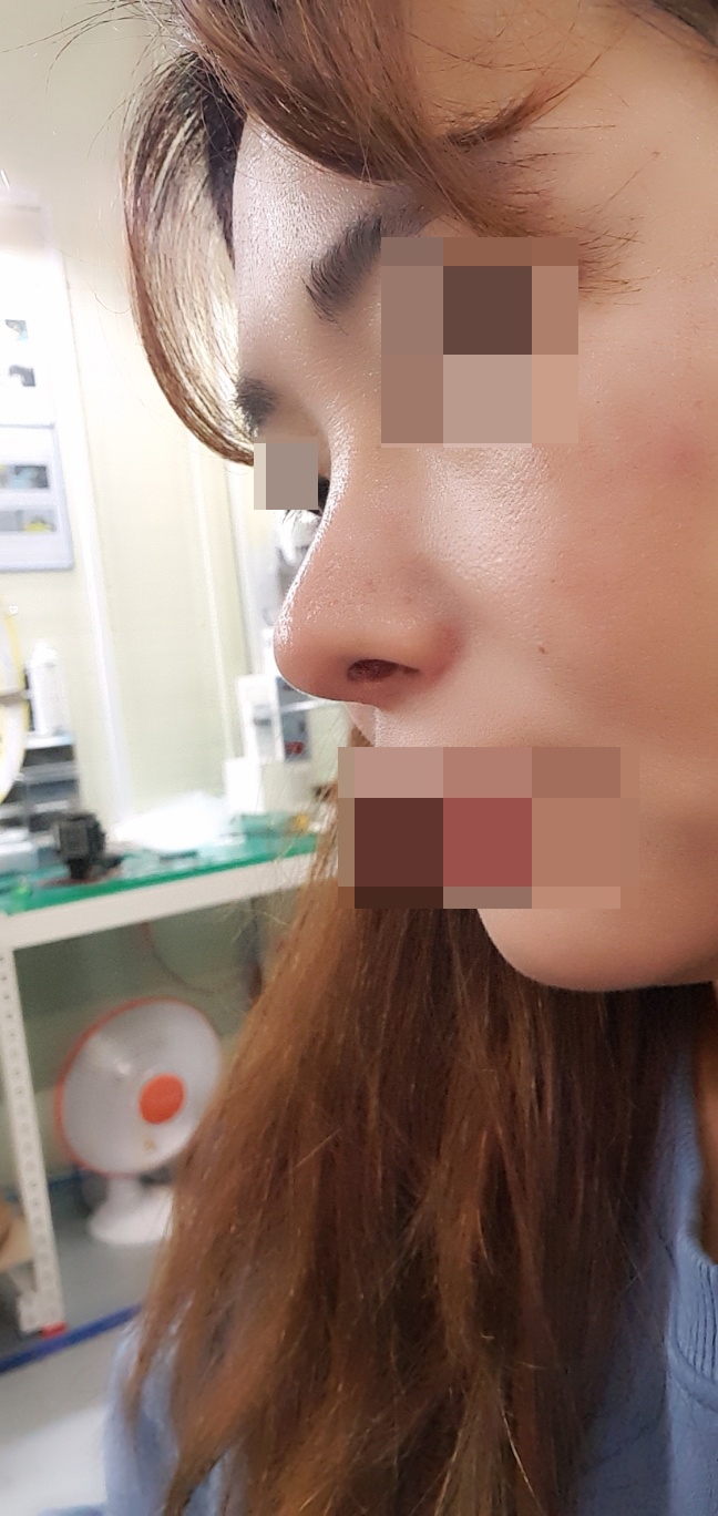 수술후 숨쉬는게 넘 좋아졌어요