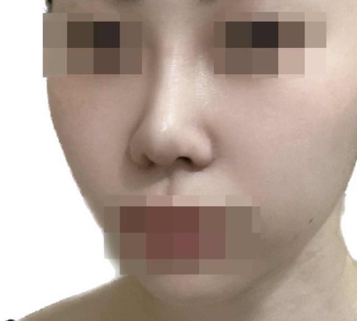 수술 3개월 차인데 코 모양도 자리잡고 붓기도 많이 빠져 맘에 들어요~