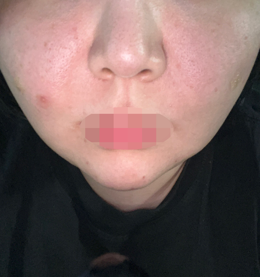 항상 푸석한 피부 고민으로 리쥬란 꾸준히 받고 있어요~!!