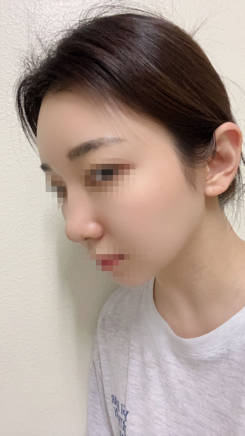 수술 두달 차 입니다! 이제 만져도 통증도 많이 줄어들었어요
