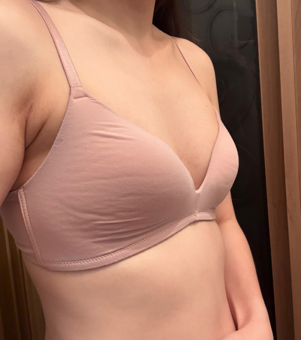 한달차부터 크기변화는 다행히 없고 흉터도 많이 옅어졌어요
