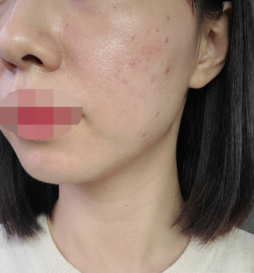 잊을만하면 또 생각나는 마성의 시술, 리쥬란 + 쥬베룩이에요ㅎㅎ