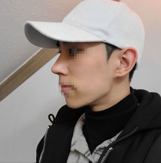 코 수술 두달째입니다.