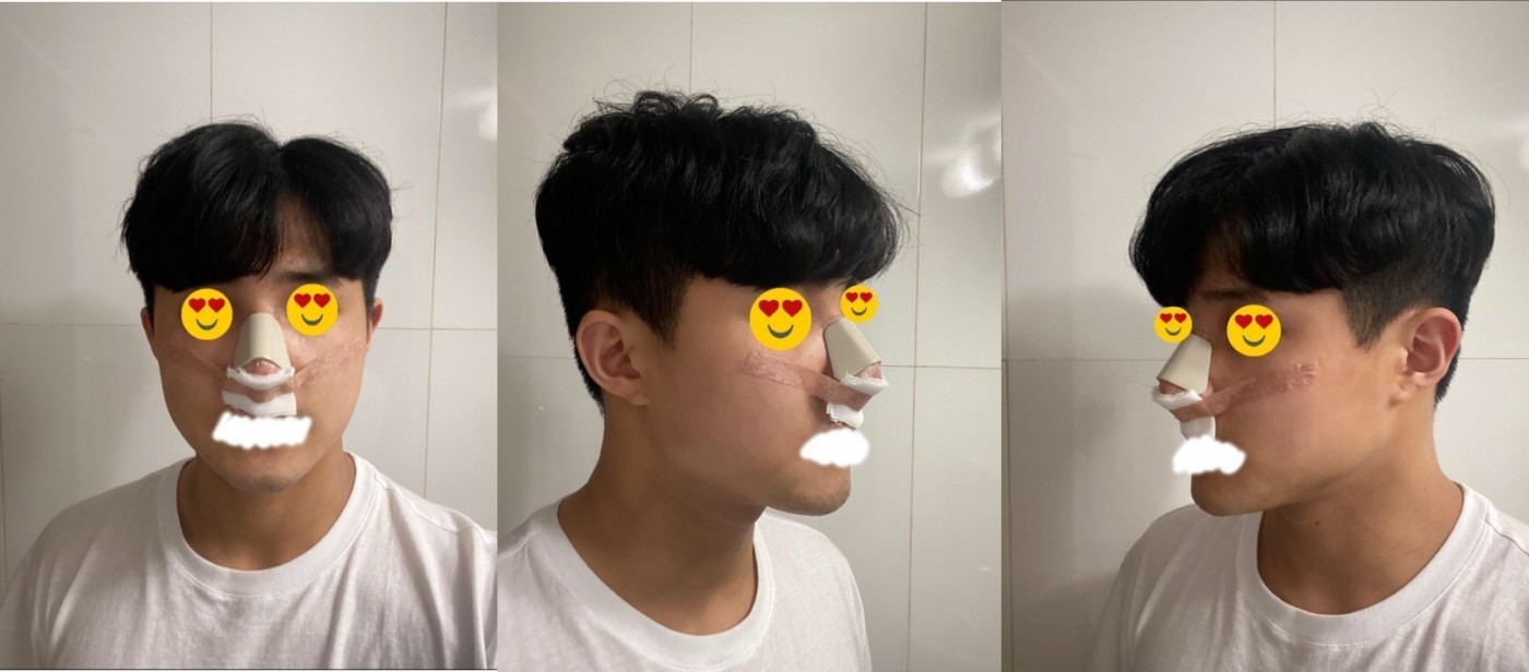 매부리 코수술