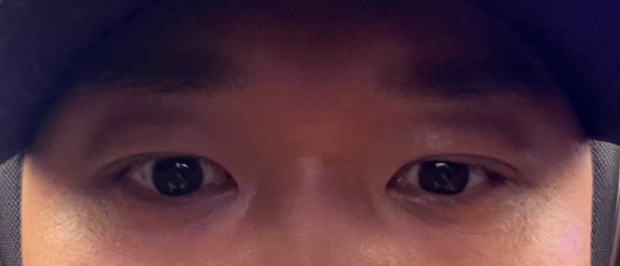 남자 비절개눈매교정 1달차, 또렷해진 눈매에 만족!